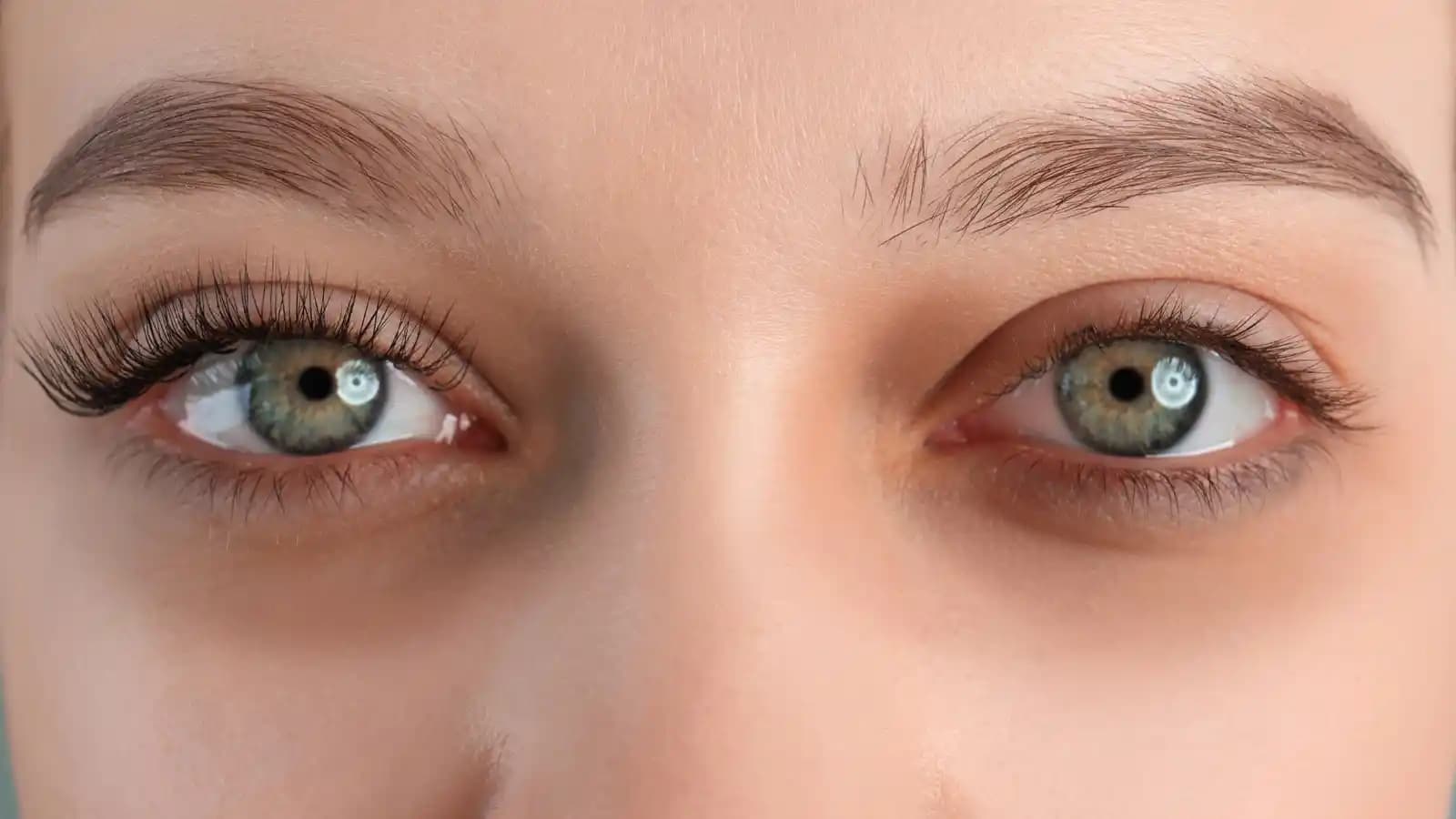 Göz Altı Halkalarını Azaltmanın Etkili Yöntemleri ve Doğal Çözüm İpuçları