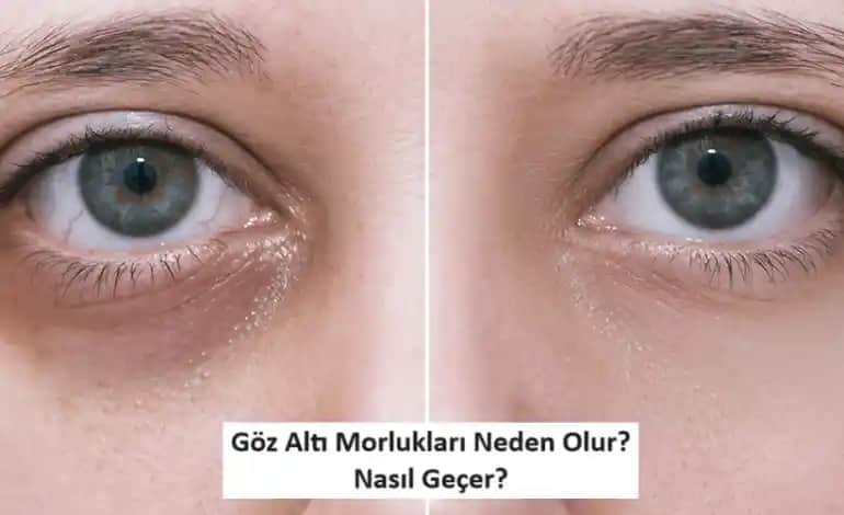 Göz Altı Halkalarının Nedenleri ve Etkili Çözüm Yöntemleri