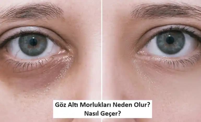 Göz Altı Halkalarının Nedenleri ve Etkili Çözüm Yöntemleri