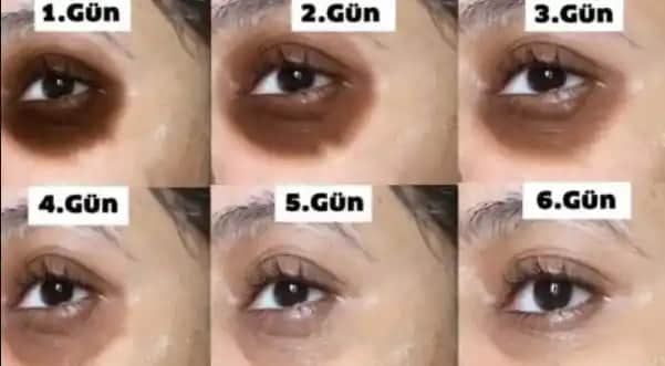 Göz Altı Kararmaları ve Vitamin Eksiklikleri: Nedenleri, Çözümleri ve Doğru Takviye Seçenekleri