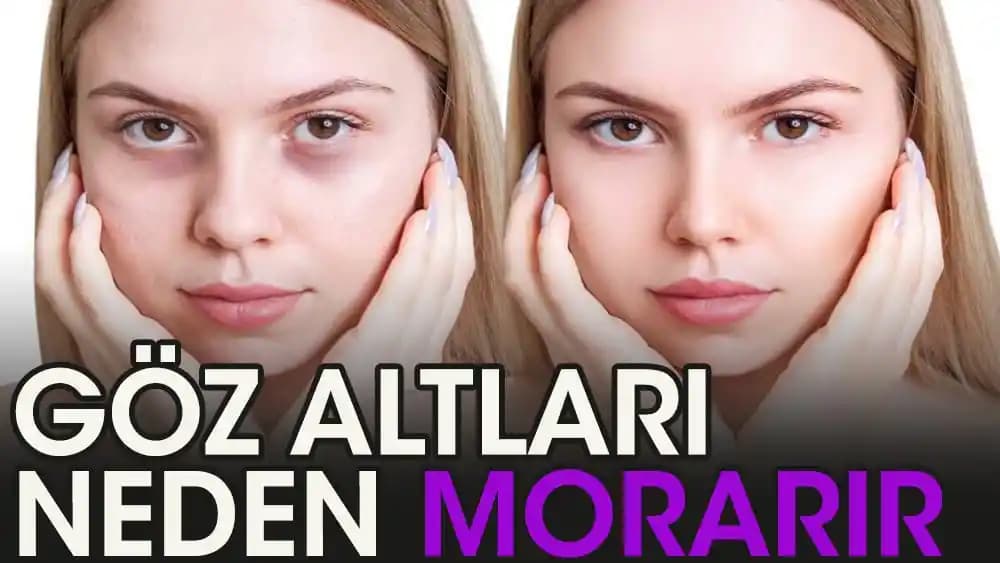 Göz Altı Morarması Nedenleri, Belirtileri ve Etkili Çözüm Yöntemleri