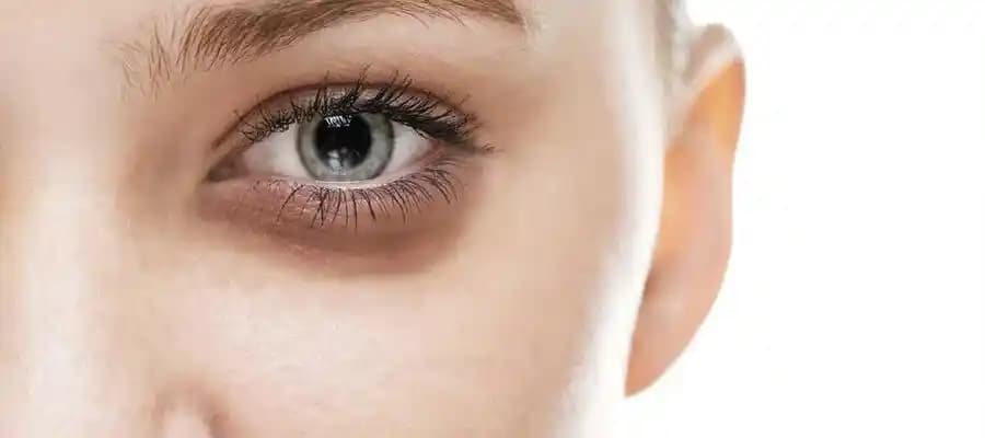 Göz Altı Morluklarına Karşı Etkili Yöntemler ve Bakım Tavsiyeleri