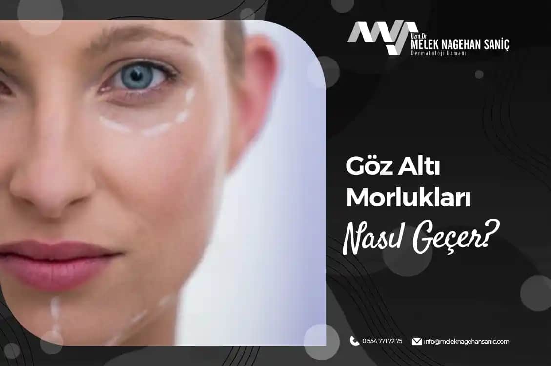 Göz Altı Morluklarını Azaltmanın Etkili ve Doğal Yolları Rehberi