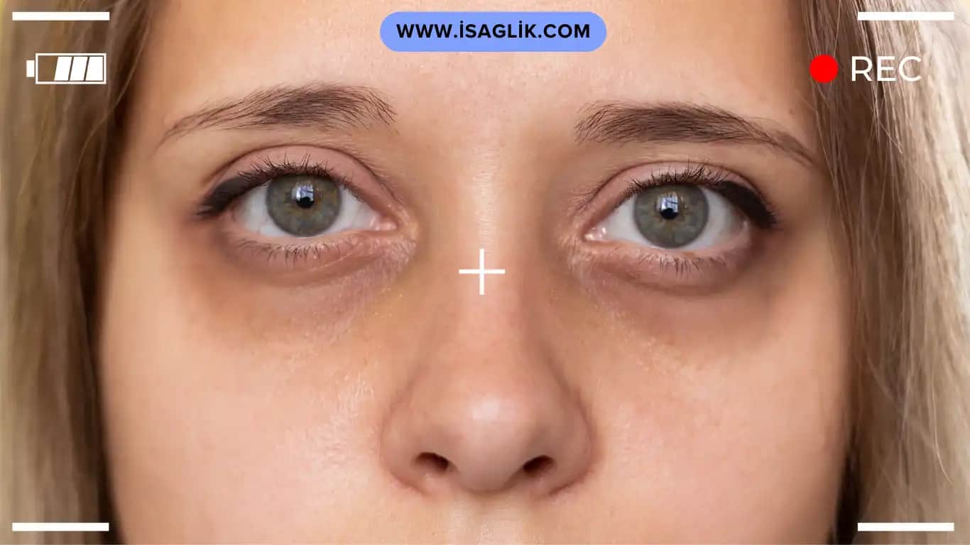 Göz Altı Morluklarının Nedenleri ve Etkili Çözüm Yolları Hakkında Detaylı Bilgi