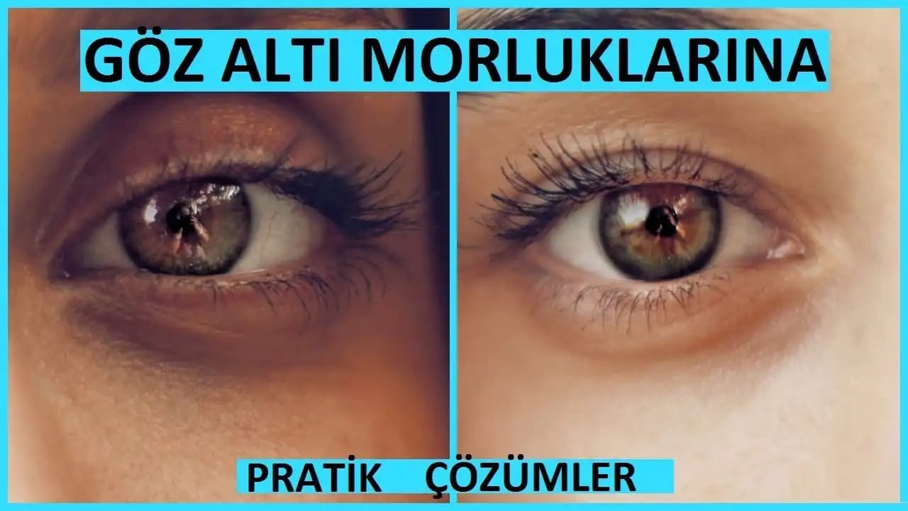 Göz Altı Morluklarının Nedenleri ve Etkili Çözüm Yolları Hakkında Kapsamlı Rehber