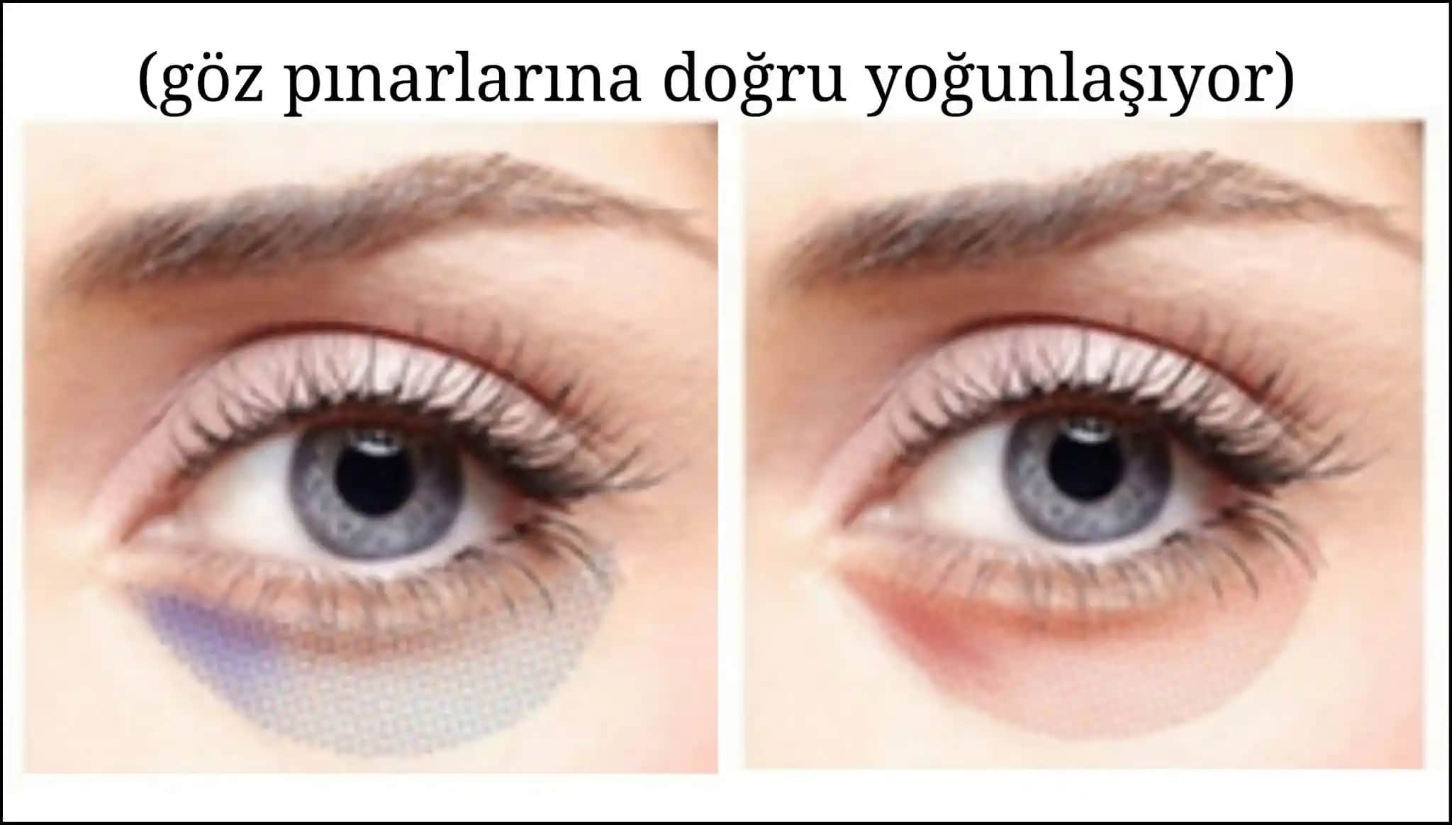 Göz Altı Morluklarının Tipleri ve Etkili Çözüm Yolları Hakkında Kapsamlı Bilgi