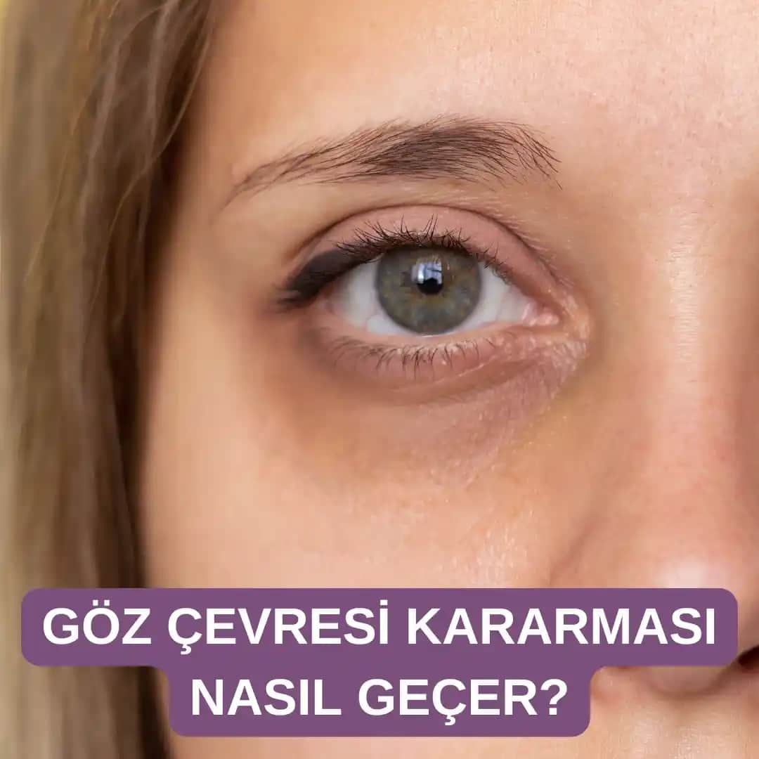 Göz Çevresi Kararmaları Nedenleri ve Etkili Çözüm Yöntemleri Analizi