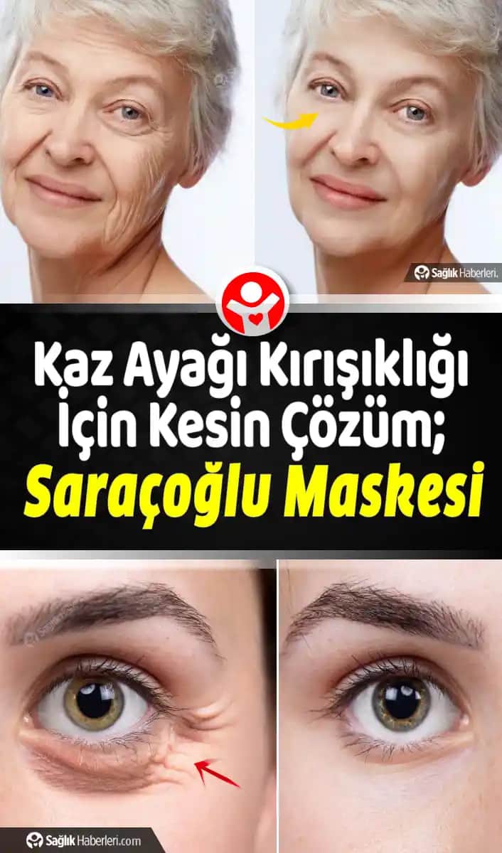 Göz Çevresi Kaz Ayağı Kırışıklıkları Nasıl Azaltılır ve Gelişmesini Önler