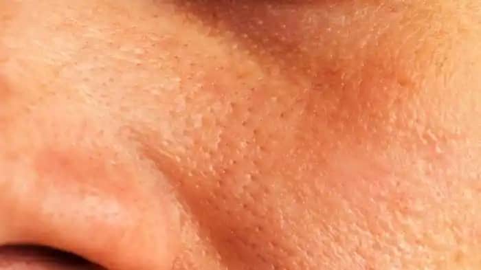 Göz Çevresi Kırışıklıklarını Azaltma Yöntemleri ve Etkili Çözüm Tavsiyeleri