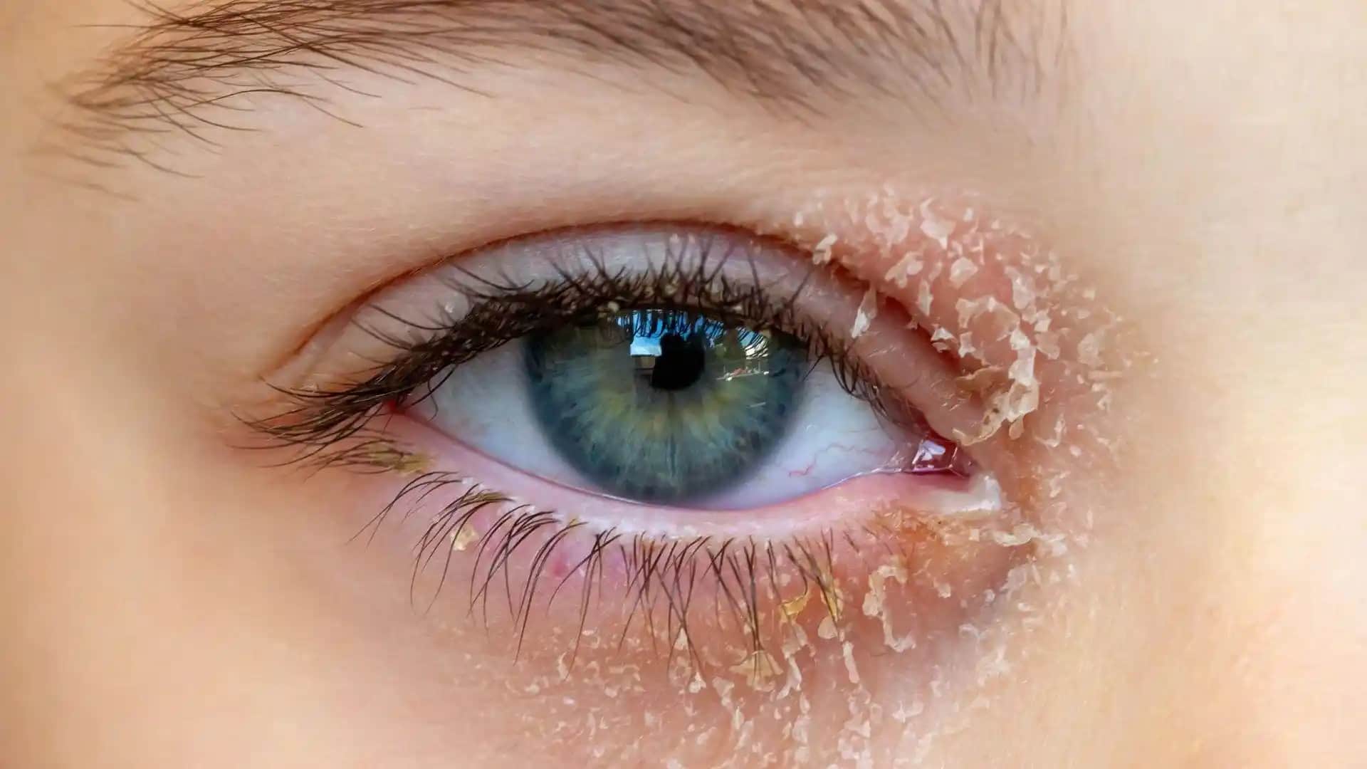 Göz Egzaması ve Kozmetik Ürün Seçimi: Göz Sağlığını Koruma Yöntemleri