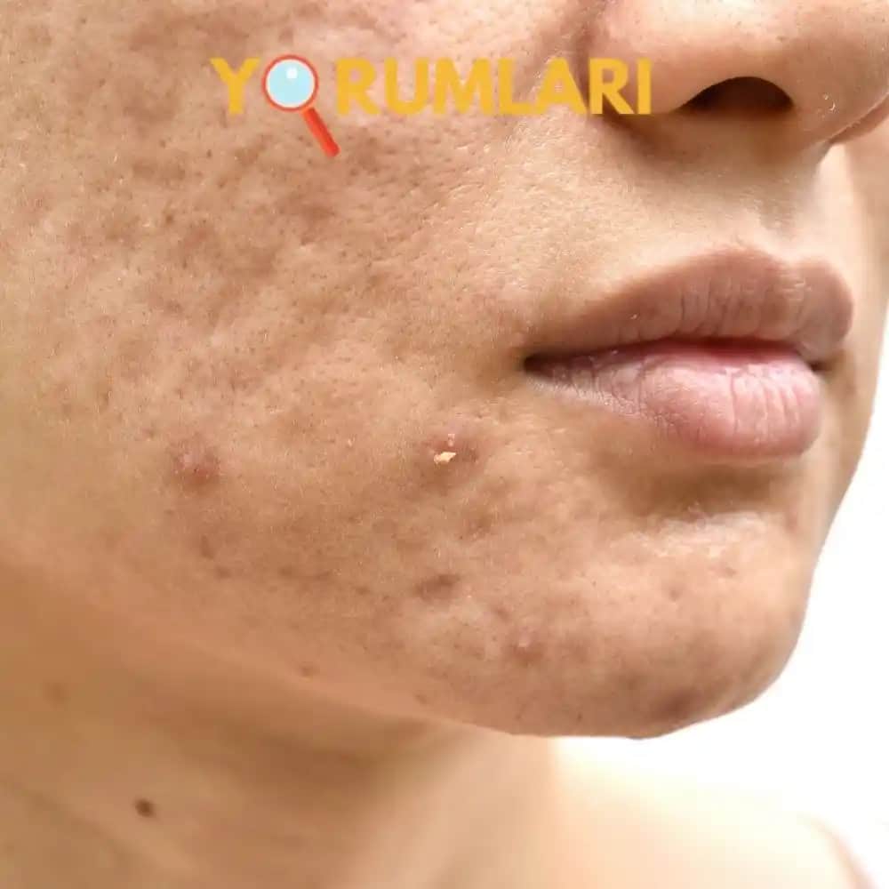 Göz Gözeneklerinin Büyümesi Nedenleri ve Etkili Çözüm Yöntemleri