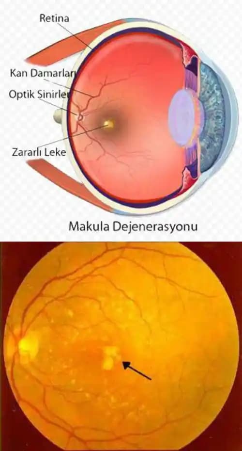 Göz İçi Sarı Lekelerinin Nedenleri ve Estetik ile Sağlık Üzerindeki Etkileri