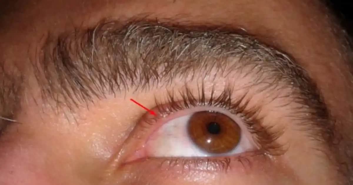 Göz İçinde Çıkan Sivilceler: Nedenleri, Belirtileri ve Tedavi Seçenekleri