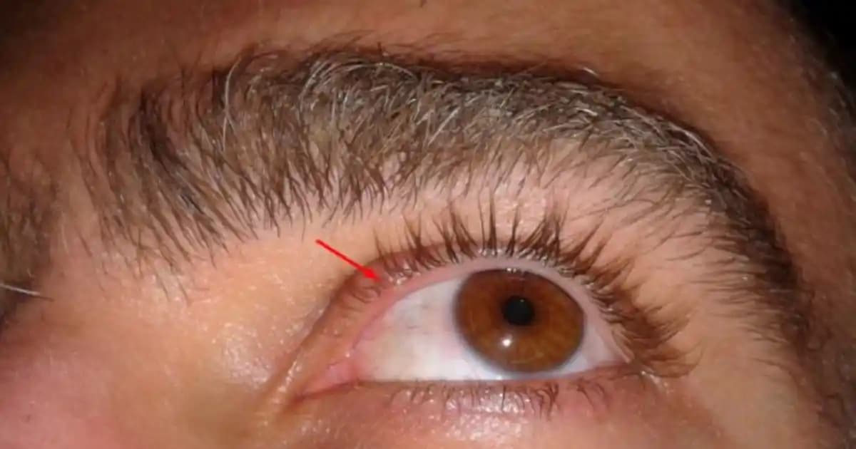 Göz İçinde Çıkan Sivilceler: Nedenleri, Belirtileri ve Tedavi Seçenekleri