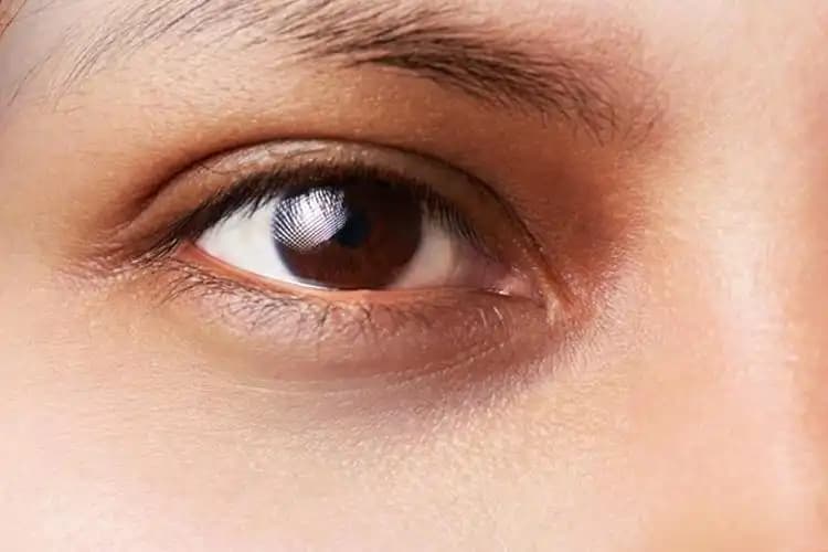 Göz Kapağı Kararması Nasıl Geçer? Doğal ve Medikal Çözüm Yöntemleri