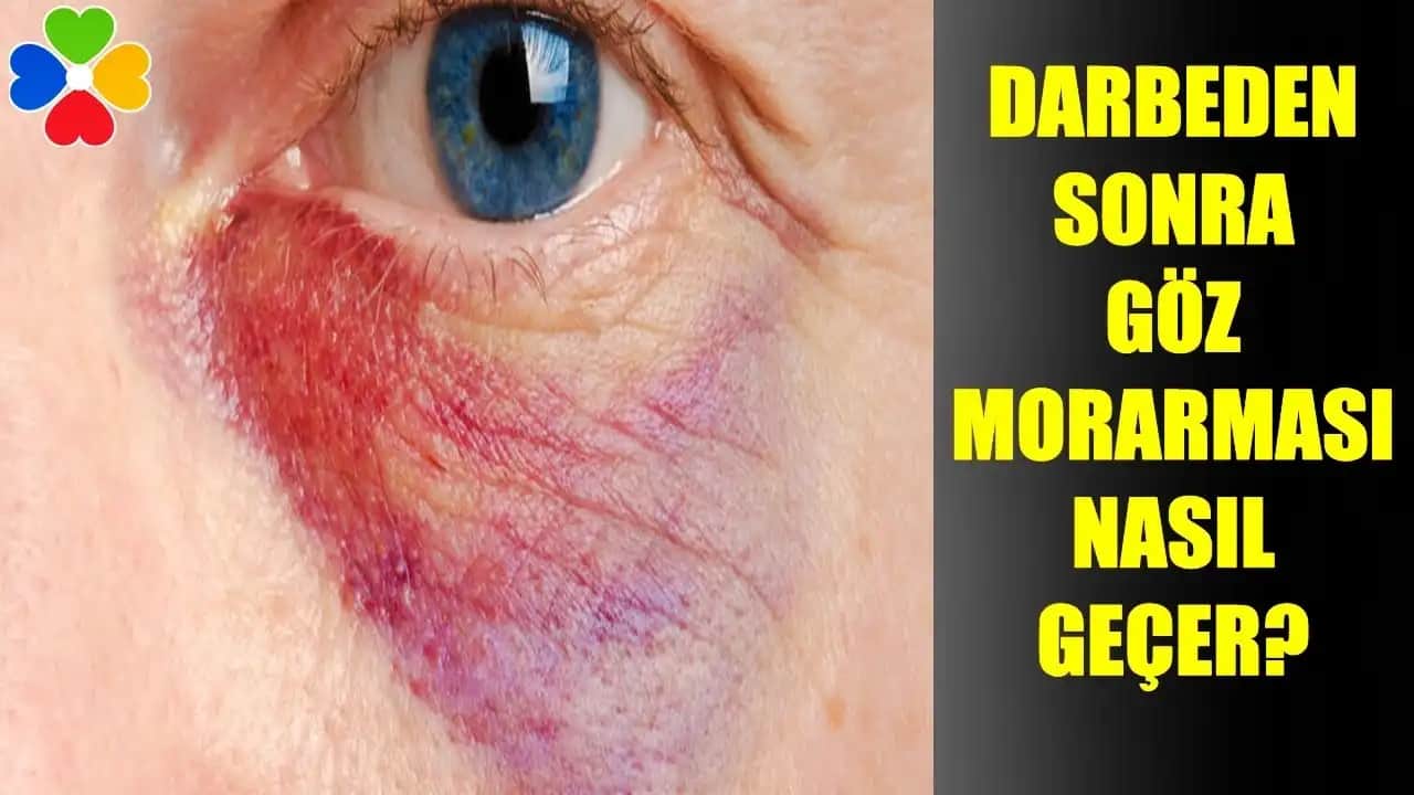 Göz Kapağında Morlukların Nedenleri ve Kozmetik Çözüm Yöntemleri