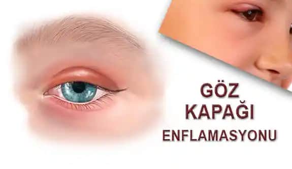 Göz Kapaklarındaki Kuruluk: Nedenleri, Belirtileri ve Etkili Çözüm Yolları
