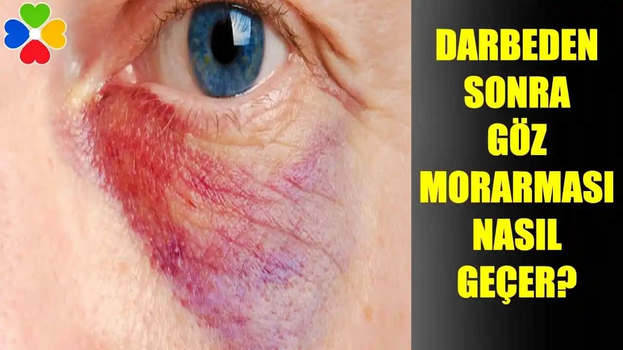 Göz Kapaklarındaki Morarmanın Nedenleri, Belirtileri ve Etkili Çözüm Yolları