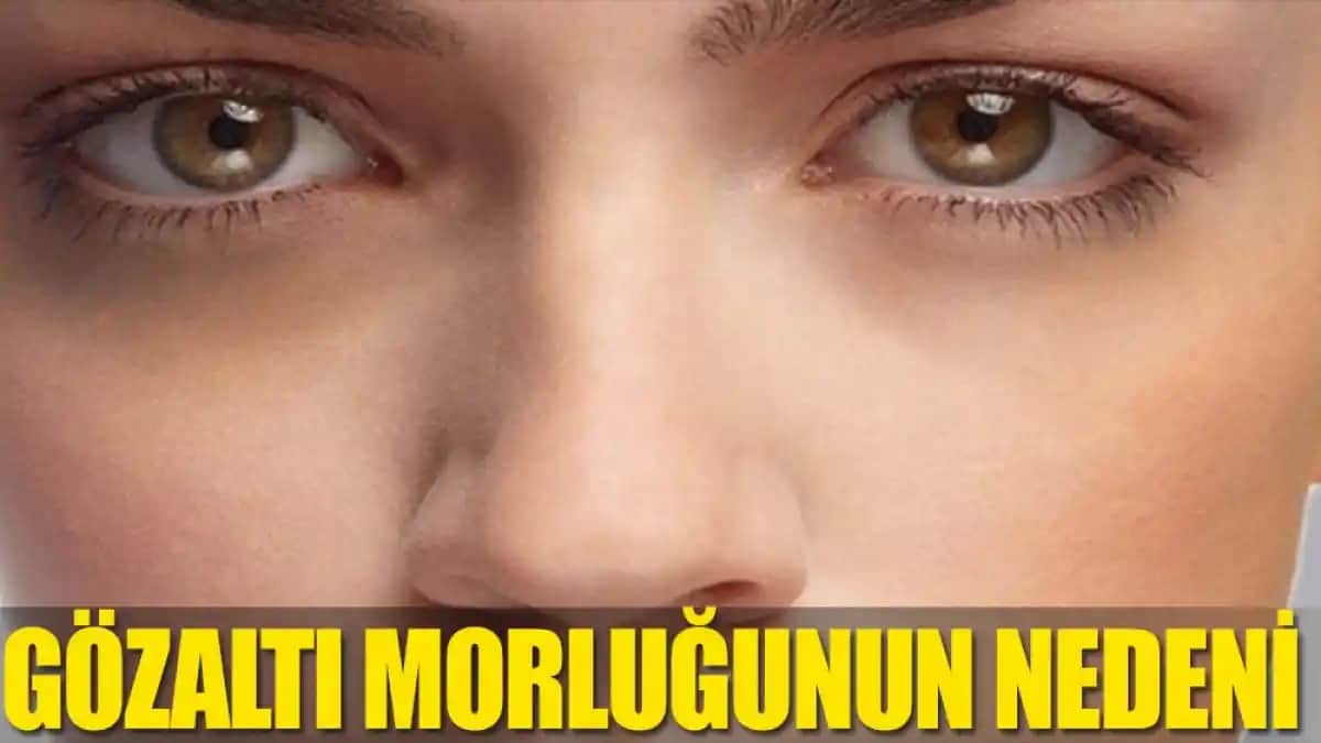 Göz Morarmasının Nedenleri ve Etkili Kozmetik ile Sağlık Yaklaşımları