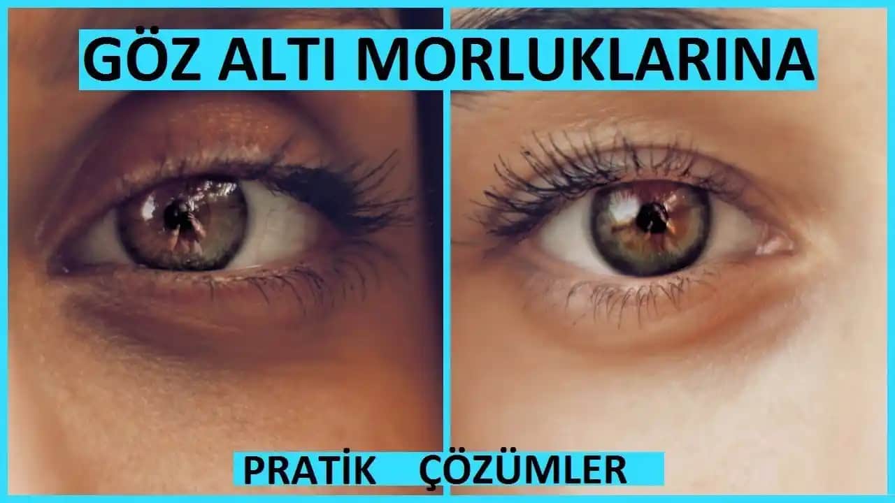 Göz Morluklarını Azaltma ve Geçirme Yöntemleri Hakkında Kapsamlı Rehber