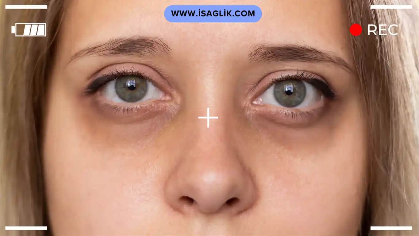 Göz Morluklarının Nedenleri ve Kozmetik Çözümlerle Göz Sağlığını Koruma Yöntemleri