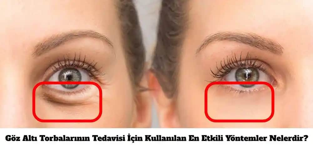 Göz Torbaları Neden Olur ve Etkili Çözüm Yöntemleri Nelerdir