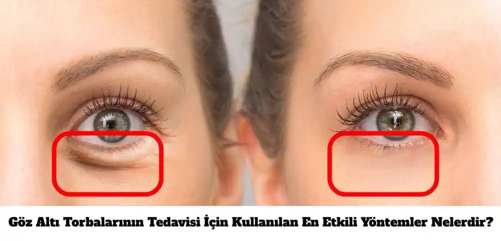Göz Torbaları Neden Olur ve Etkili Çözüm Yöntemleri Nelerdir