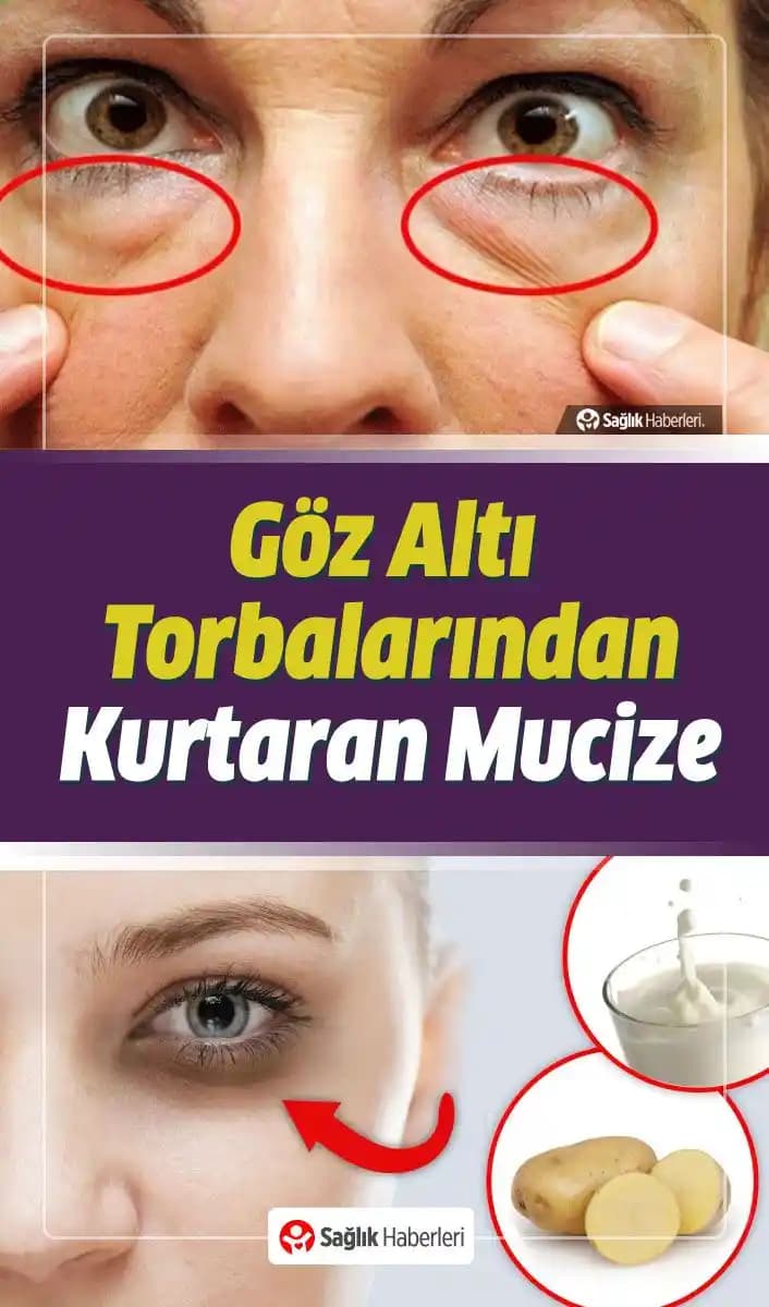 Göz Torbalarına Karşı Etkili Yöntemler ve Günlük Bakım İpuçları