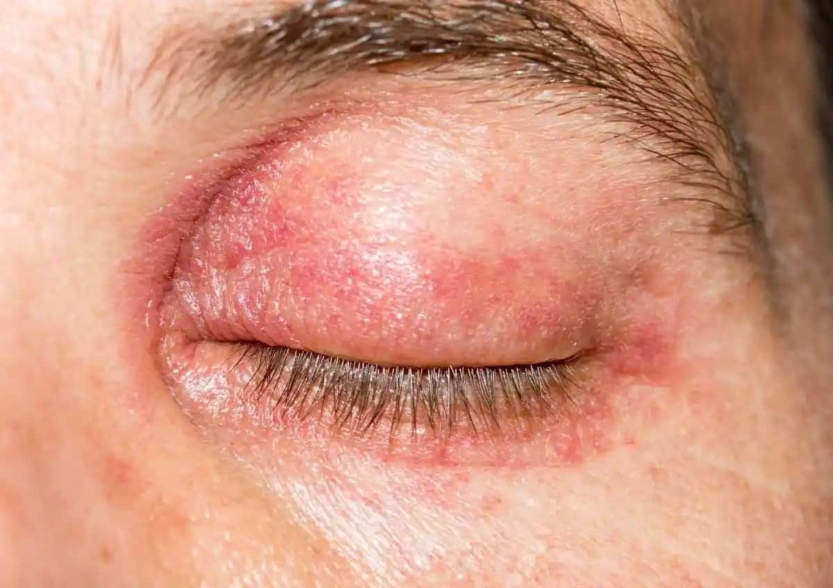 Göz Üstü Egzama ve Kozmetik Ürünlerin Etkisi: Doğru Bakım ve Koruma Yöntemleri