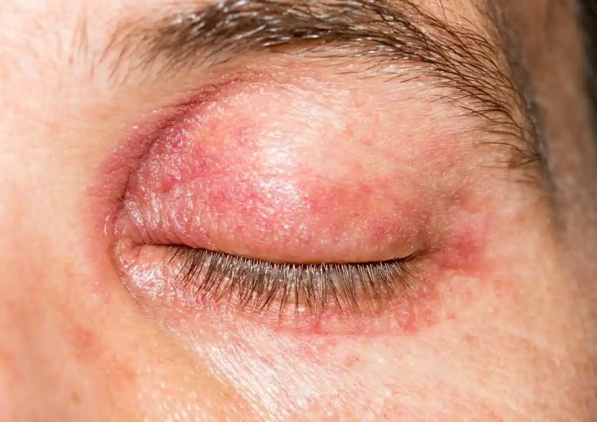 Göz Üstü Egzama ve Kozmetik Ürünlerin Etkisi: Doğru Bakım ve Koruma Yöntemleri