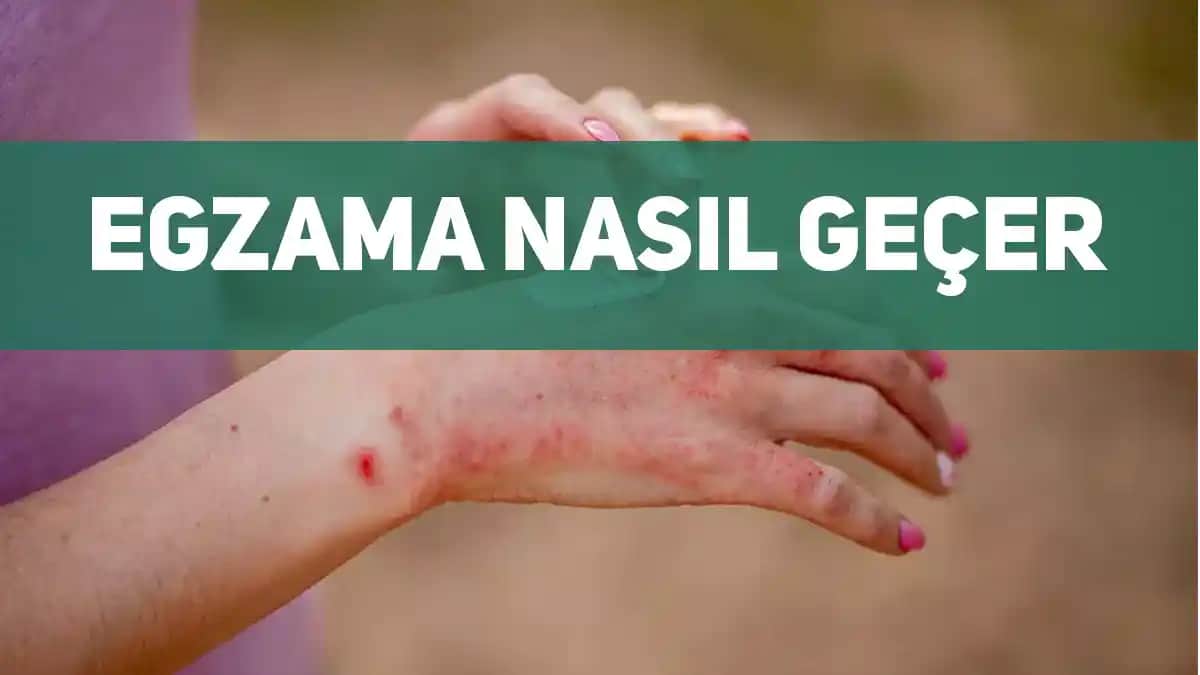 Gözde Egzama Nasıl Geçer: Belirtiler, Nedenler ve Etkili Tedavi Yöntemleri