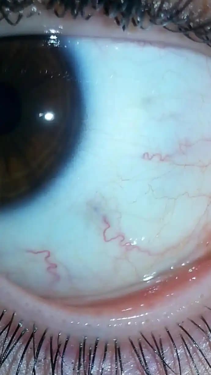 Gözde Mor Lekelerin Nedenleri ve Etkili Çözüm Yolları Hakkında Bilmeniz Gerekenler