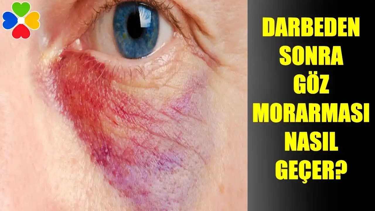 Gözde Morarma Nedenleri ve Estetik ile Sağlık Boyutları Hakkında Detaylı Bilgi