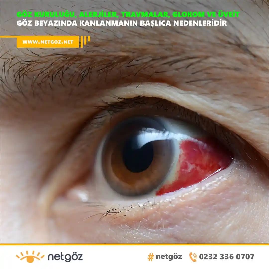 Gözdeki Kılcal Damar Sorunu ve Kozmetik Çözüm Yöntemleri Hakkında Bilgiler