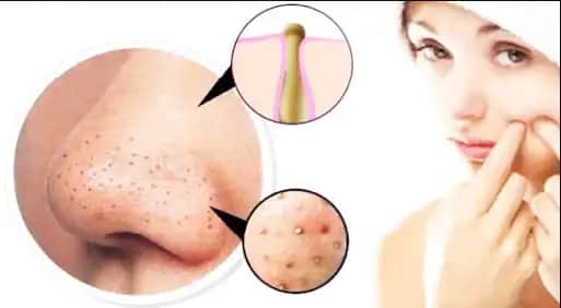 Gözeneklere Kesin Çözüm: Cilt Bakımında Derinlemesine Yaklaşımlar ve Etkili Yöntemler