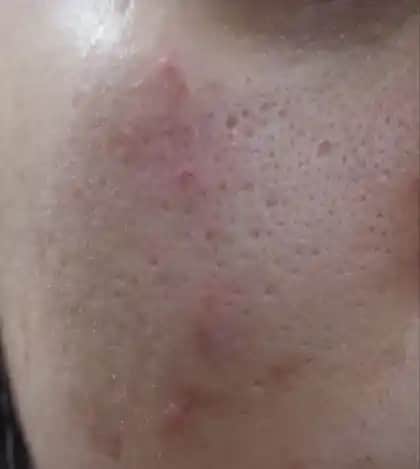 Gözenekleri Sıkılaştırıcı Yöntemler ve Cilt Sağlığı İçin Tavsiyeler