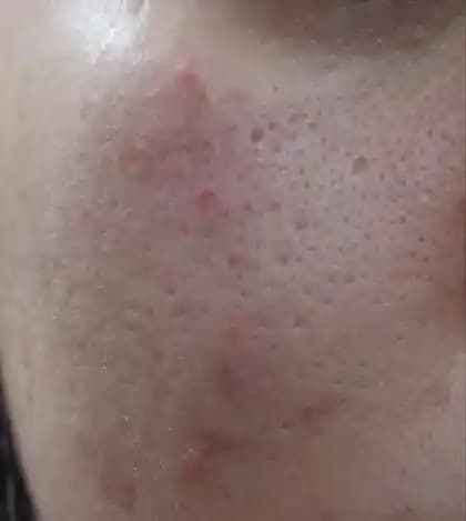 Gözenekleri Sıkılaştırıcı Yöntemler ve Cilt Sağlığı İçin Tavsiyeler