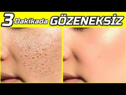 Gözenekleri Yok Etme Rehberi: Pürüzsüz ve Sağlıklı Bir Cilt İçin Güncel Yaklaşımlar