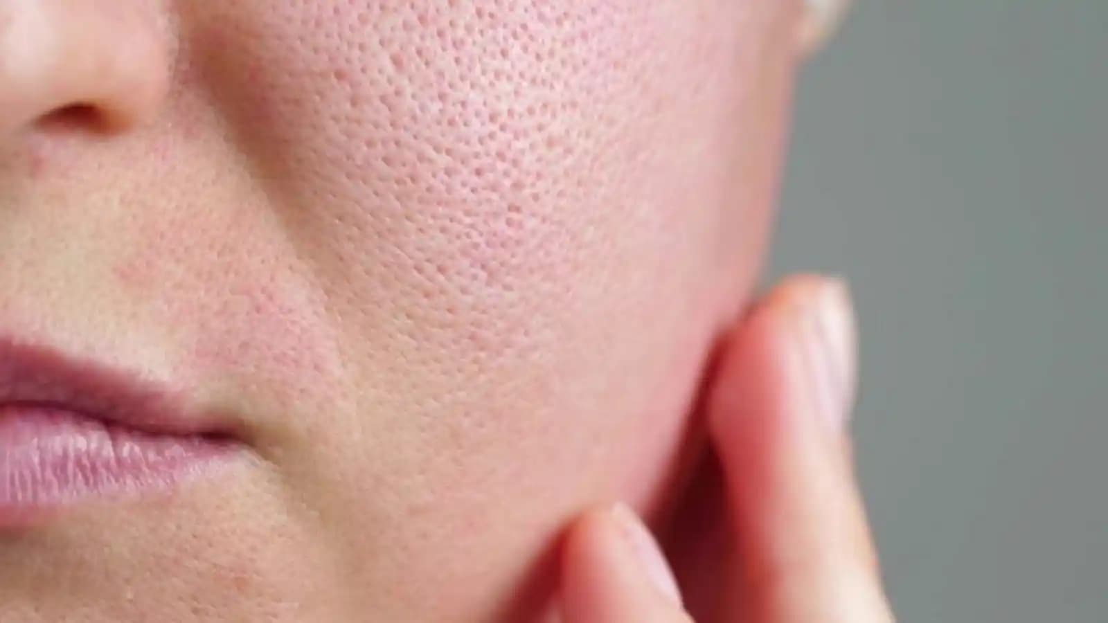 Gözeneklerin Büyüme Nedenleri ve Cilt Sağlığını Koruma Yöntemleri