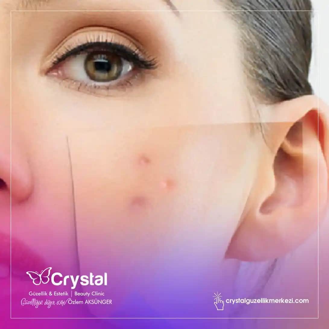 Gözeneklerin Tıkanmasının Nedenleri ve Cilt Sağlığını Koruma Yöntemleri