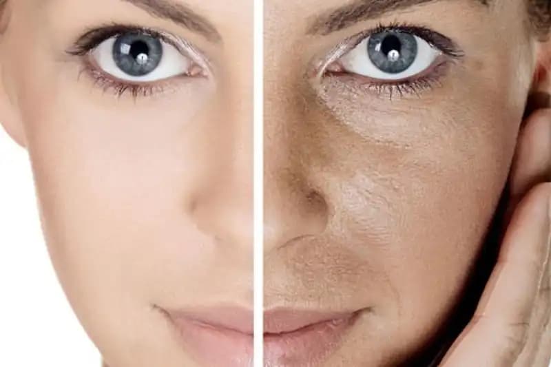 Gözenekli Cilt Tedavisi ve Bakım Yöntemleri: Sağlıklı ve Pürüzsüz Cilt İçin Rehber