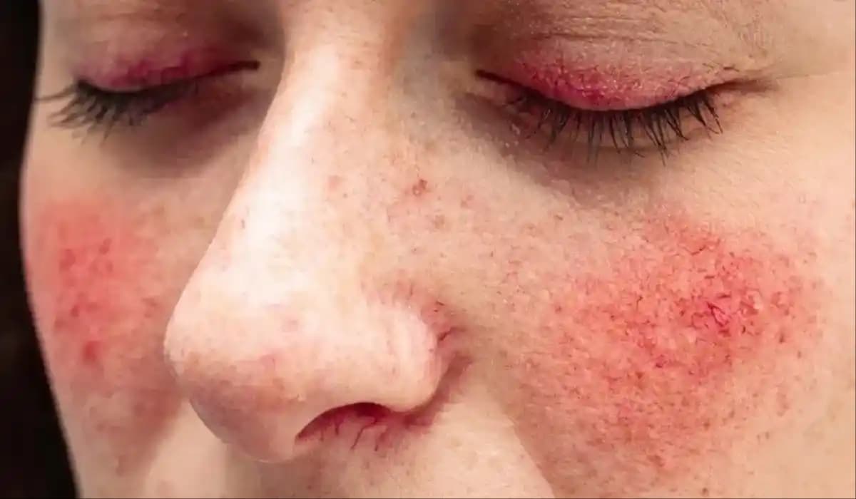 Gül Hastalığı Nedenleri, Belirtileri ve Tedavi Yöntemleri Hakkında Detaylı Bilgi