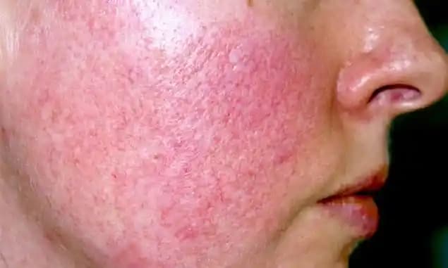 Gül Hastalığı Nedir Bulaşıcı Mıdır ve Nasıl Korunulur