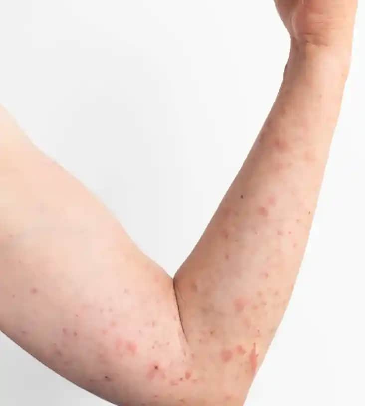 Gül Hastalığı ve Ciltteki Etkileri: Kozmetik Yaklaşım ve Bakım Önerileri