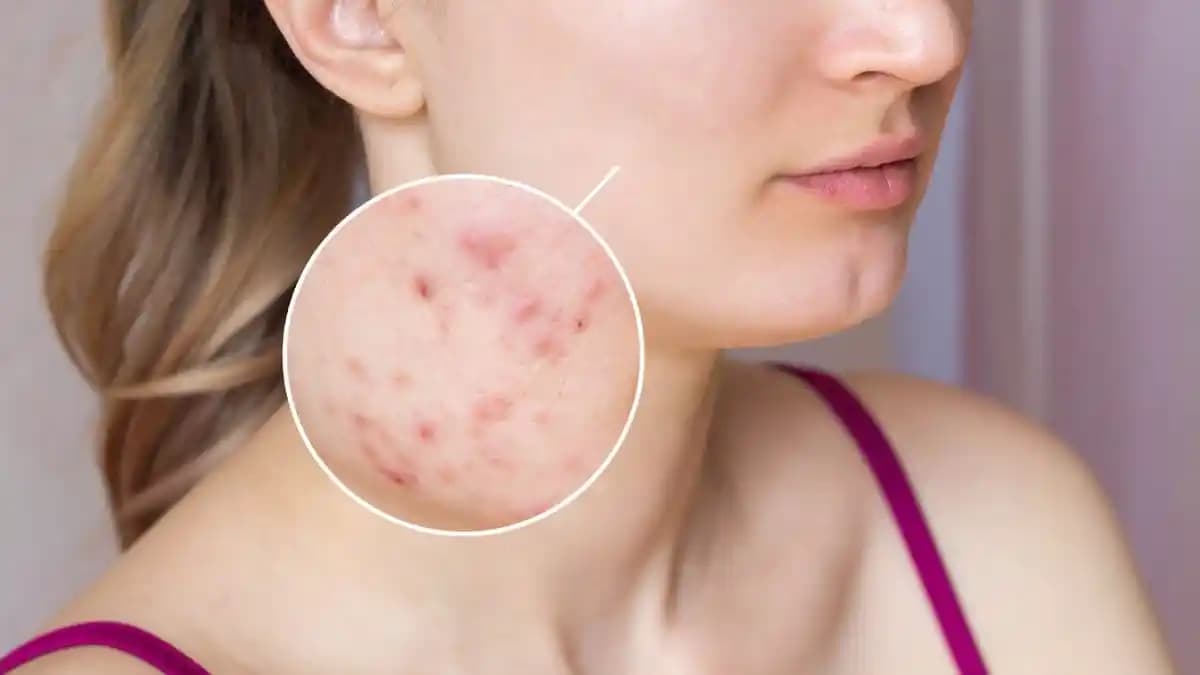 Gül Hastalığı ve Kozmetik Yaklaşımlar: Cilt Sağlığında Bilinçli ve Doğru Bakım