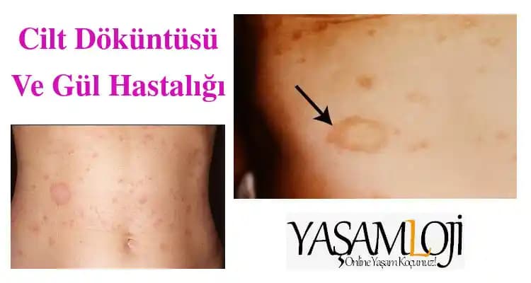 Gül Hastalığı ve Kozmetik Yaklaşımlar: Cilt Sağlığını Koruma Rehberi