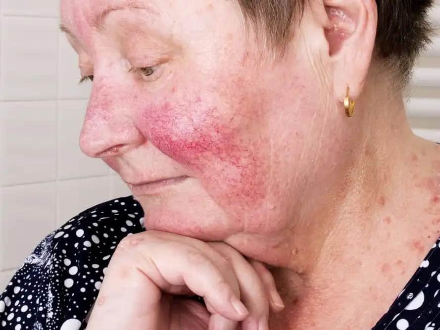 Gül Hastalığı ve Kozmetik Yaklaşımları: Cilt Bakımında Doğru Ürün Seçimi ve Koruma Yöntemleri