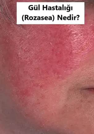 Gül Hastalığı ve Tekrarlama Olasılığı: Kozmetik Perspektiften Derinlemesine İnceleme