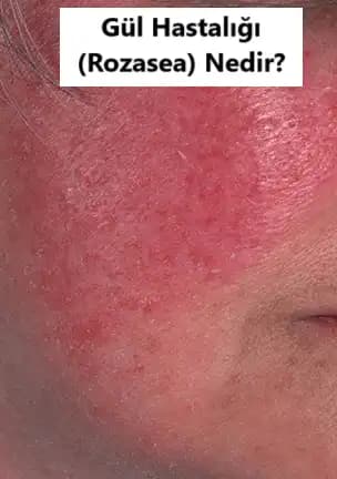 Gül Hastalığı ve Tekrarlama Olasılığı: Kozmetik Perspektiften Derinlemesine İnceleme
