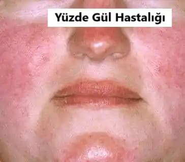Gül Hastalığı ve Yüzde Oluşan Değişiklikler: Kozmetik ve Tedavi Yaklaşımları